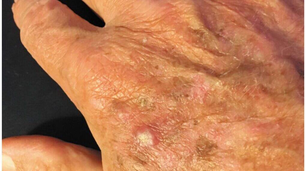 Elderly Men at High Risk: Global Skin Cancer Cases Skyrocket Since 1990