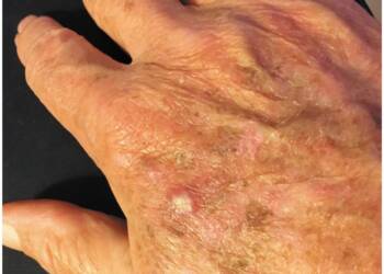 Elderly Men at High Risk: Global Skin Cancer Cases Skyrocket Since 1990