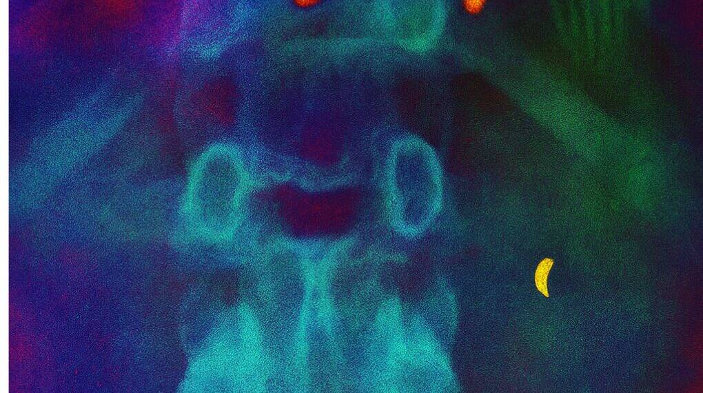 Decades-Old Toothbrush Removed from Patient’s Intestine in China