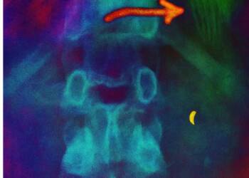 Decades-Old Toothbrush Removed from Patient’s Intestine in China