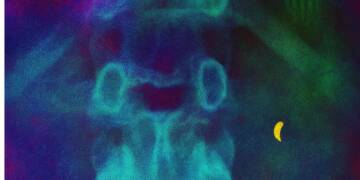 Decades-Old Toothbrush Removed from Patient’s Intestine in China